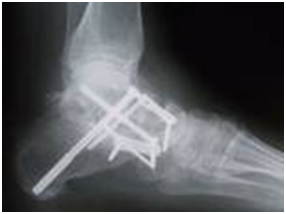 Subtalar Arthroereisis