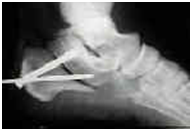 Osteotomy